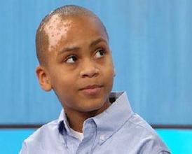 毛囊型白癜風(fēng)診療要怎么做才好?