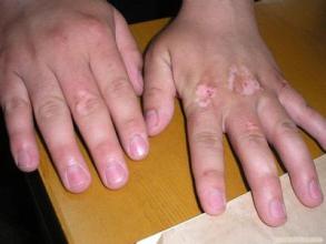 肢端型白癜風有哪些診斷標準?