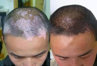 毛囊型白癜風患者在診療的時候應該避免哪些情況?