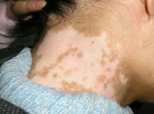 泛發型白癜風可以吃哪些食物