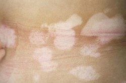 散發型白癜風有哪些危害